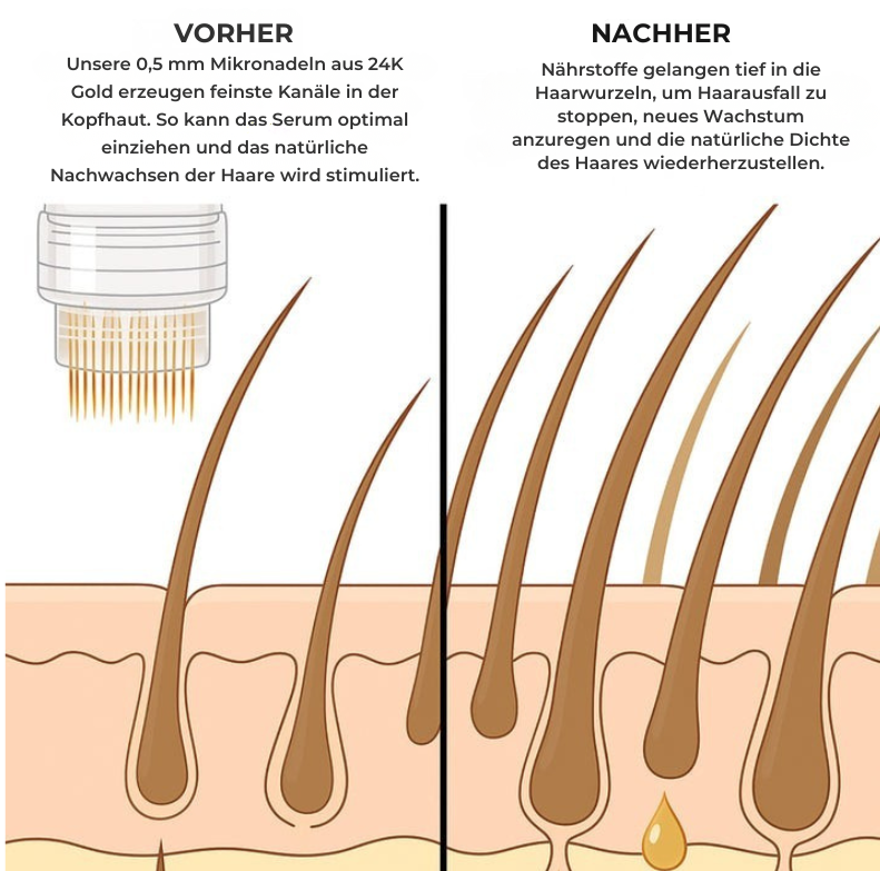 SereniaInfuse™  Haarwuchs-System